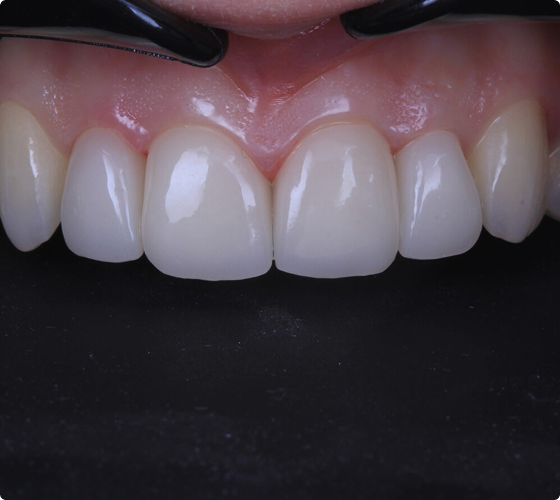 Close-up of metal-free ceramic crowns