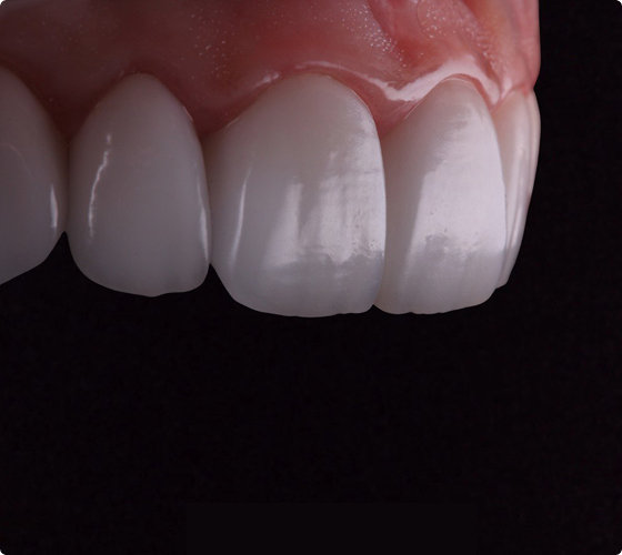 Close-up of bright white ceramic restorations